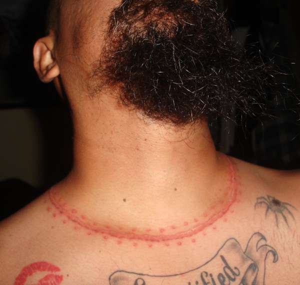neck scar.