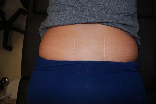 Zipper Scar Cover up Before tattoo