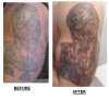 Before and After tattoo