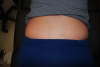 Zipper Scar Cover up Before tattoo